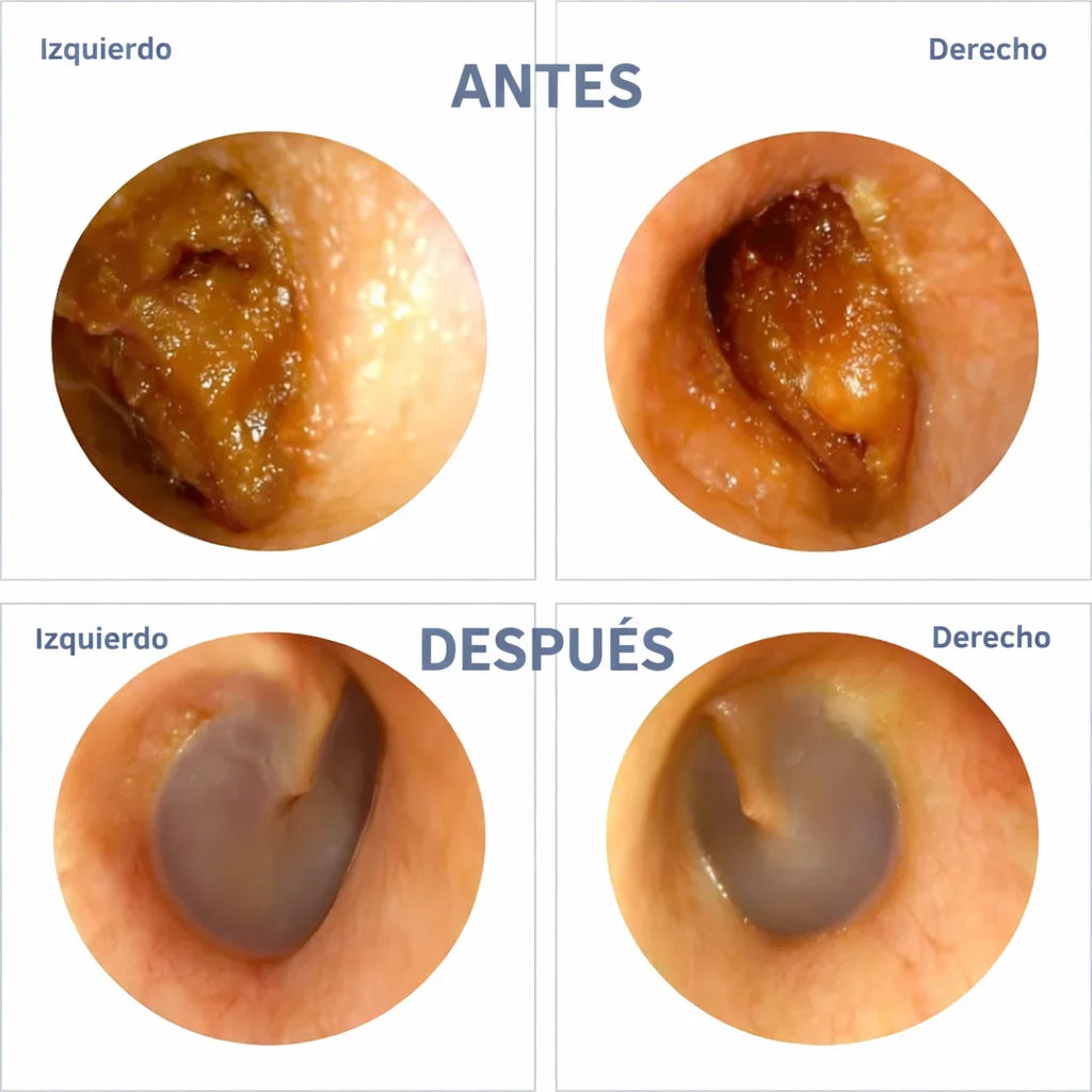 WaxClean® – Limpia tus oídos fácilmente desde casa